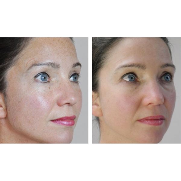 Dermaroller 540 needles with Titanium needles 0.5mm for the face - | Fashiongirl