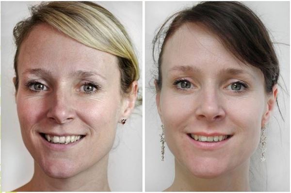 UNIQ Titanium Dermaroller 540 needles 0.25 mm. for the face - | Fashiongirl